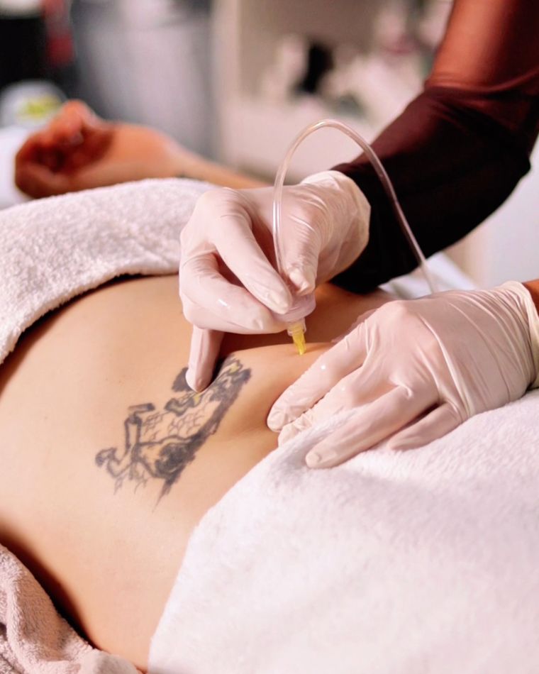 Carboxiterapia