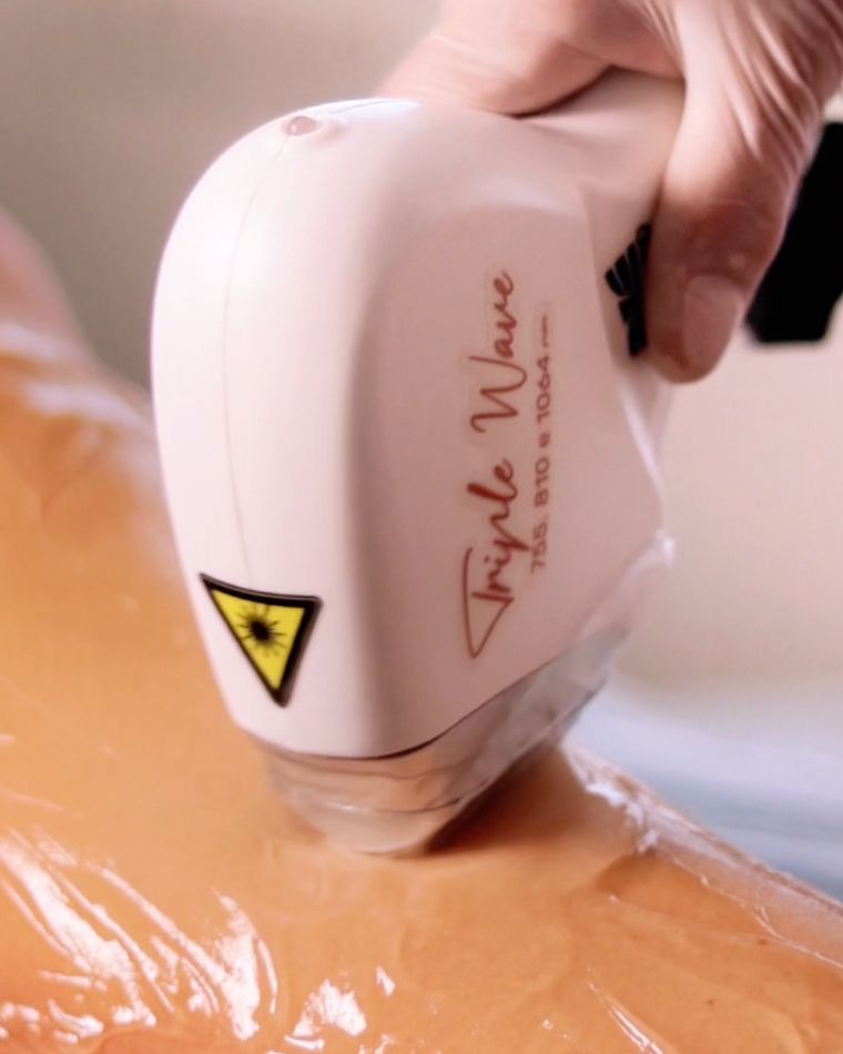 Depilação a Laser
